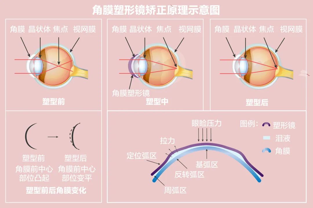 解决近视的最新进展：从基因疗法到人工智能辅助矫正